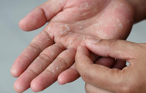 درمان پوست پوست شدن دست