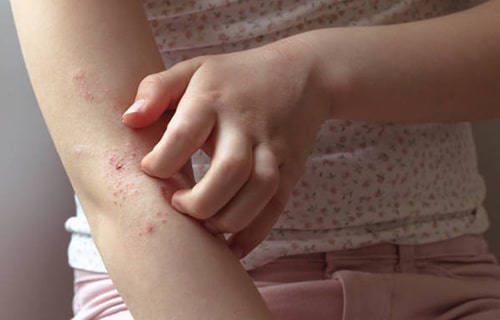 علائم بیماری اگزما در کودکان