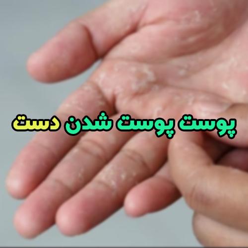 پوست پوست شدن دست؛ علت و درمان کامل