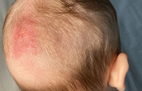 بیماری قارچ پوستی سر در کودکان