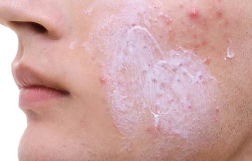 استفاده از کرم مناسب برای درمان جوش صورت