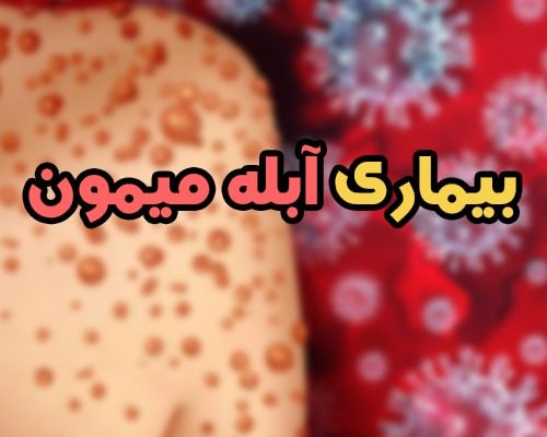 0 تا 100 بیماری آبله میمون؛ علائم + راه های پیشگیری