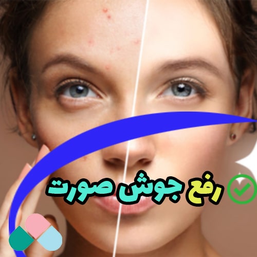 رفع جوش‌های صورت؛ برای رفع جوش های صورت چه باید کرد؟