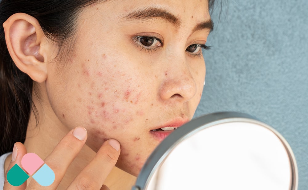 شواهد علمی از نقش ژنتیک در آکنه