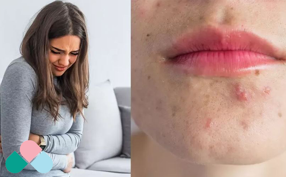 مشکلات گوارشی رایج که باعث جوش می‌شوند