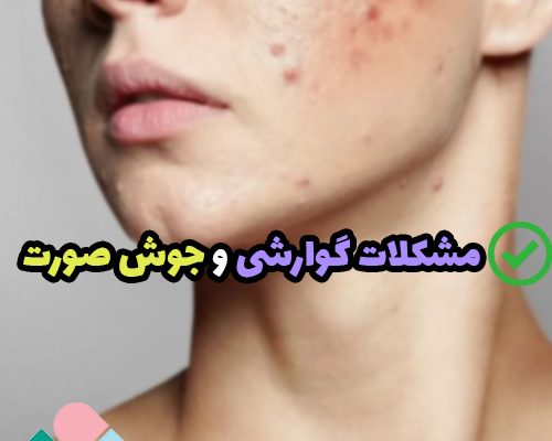 مشکلات گوارشی و جوش صورت؛ تاثیر اختلالات گوارشی بر بروز جوش