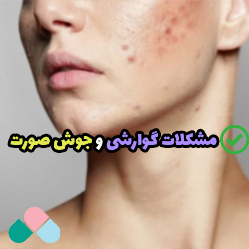 مشکلات گوارشی و جوش صورت؛ تاثیر اختلالات گوارشی بر بروز جوش
