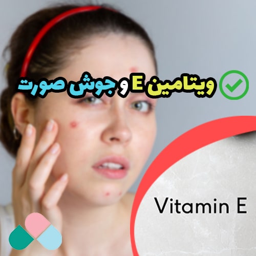 آیا ویتامین e برای جوش صورت خوب است؟