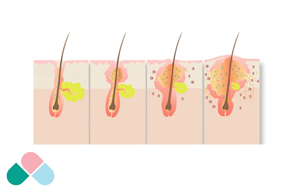 ژنتیک و نقش آن در آکنه