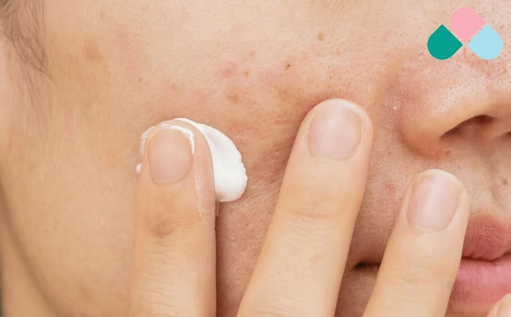 تاثیر استفاده از کرم_های ضد آفتاب در کنترل آکنه