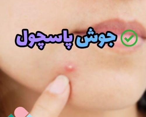 جوش پاسچول چیست؟ صفر تا صد راهکار درمان