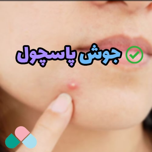 جوش پاسچول چیست؟ صفر تا صد راهکار درمان