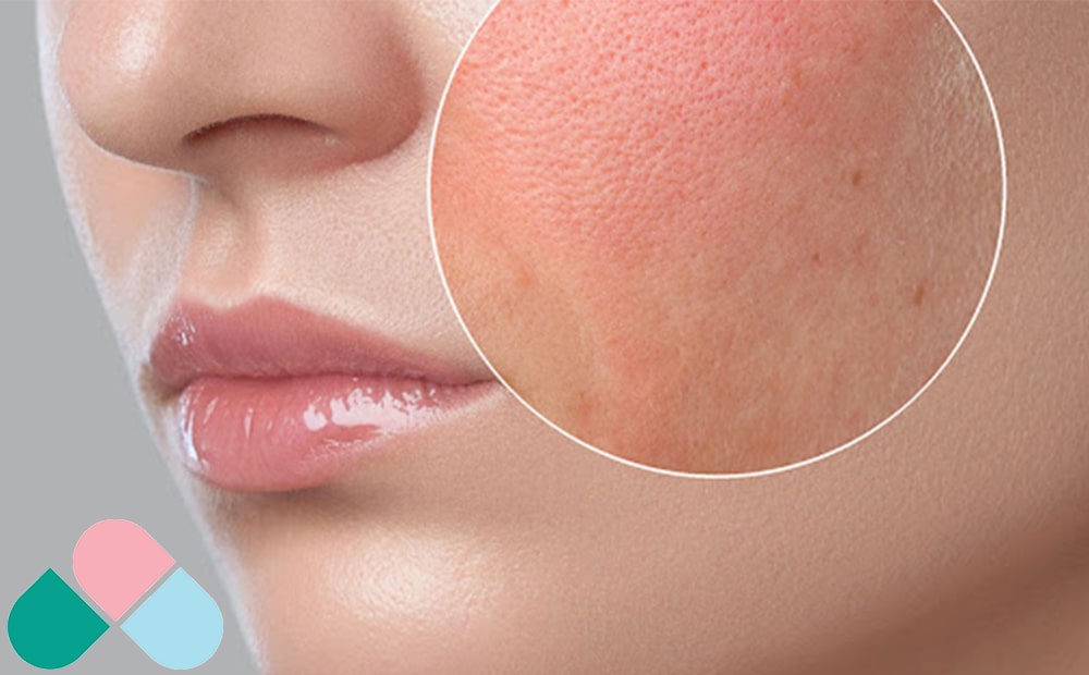 التهاب و قرمزی