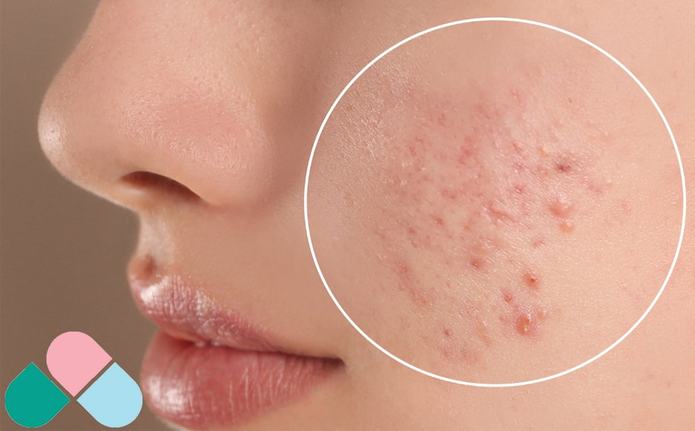 تأثیر الکل بر آکنه و جوش