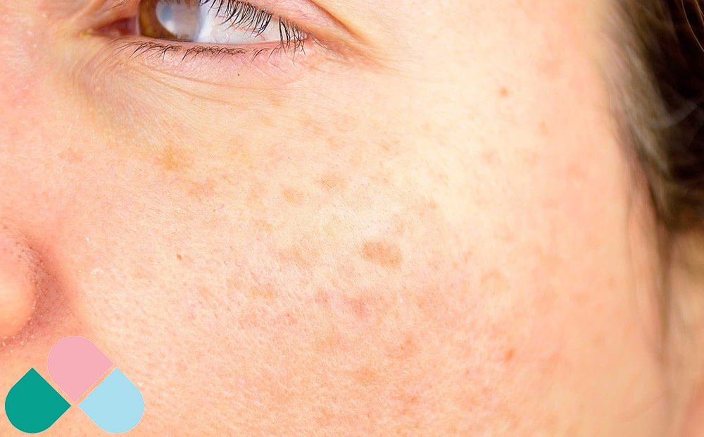 تاثیر سیگار بر رنگ و درخشندگی پوست