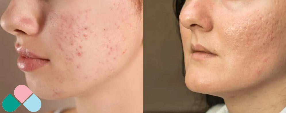 تفاوت بین لک و جای جوش صورت