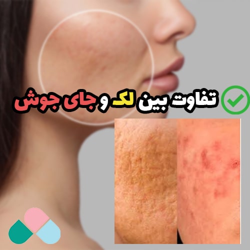 تفاوت بین لک و جای جوش صورت