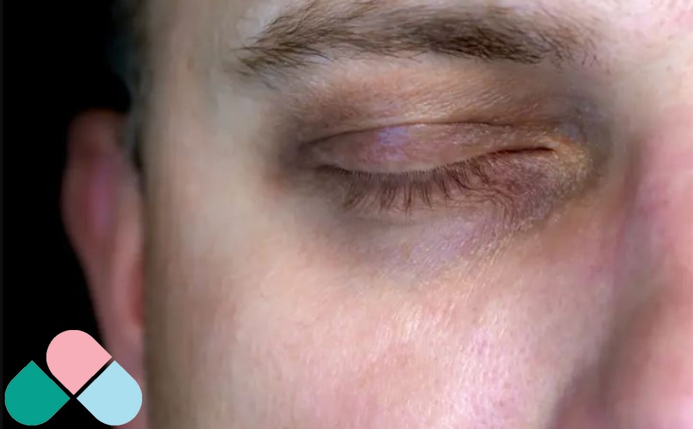 تیرگی و کدری پوست