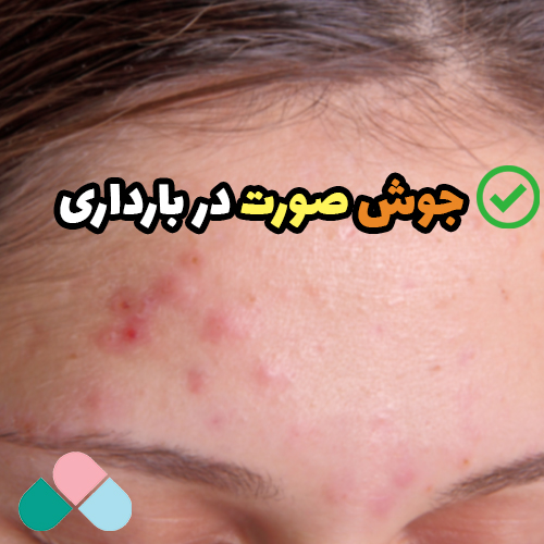 جوش صورت در بارداری؛ علت ایجاد جوش + راهکارهای درمان