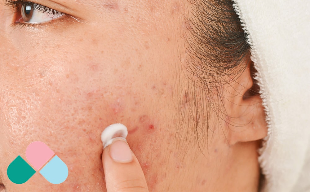 درمان مؤثر جوش_های فعال