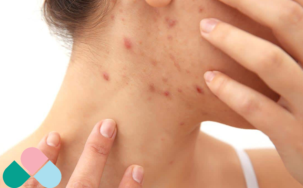 علت جوش صورت در بارداری